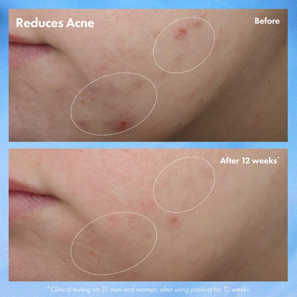 Clear Improvement™ Blemish Clearing Hydrating Lotion, 50ml